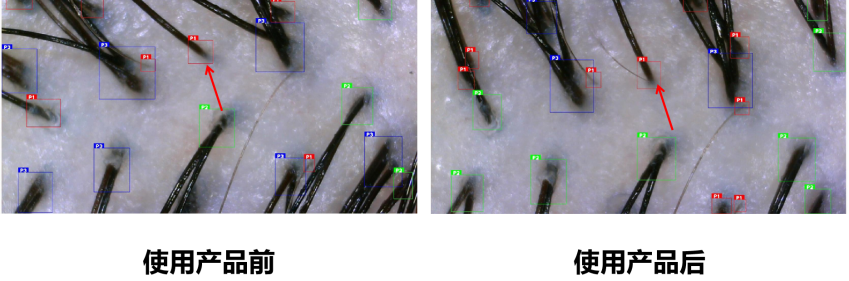 頭皮健康,紅斑,,丘疹,膿皰,評價方法